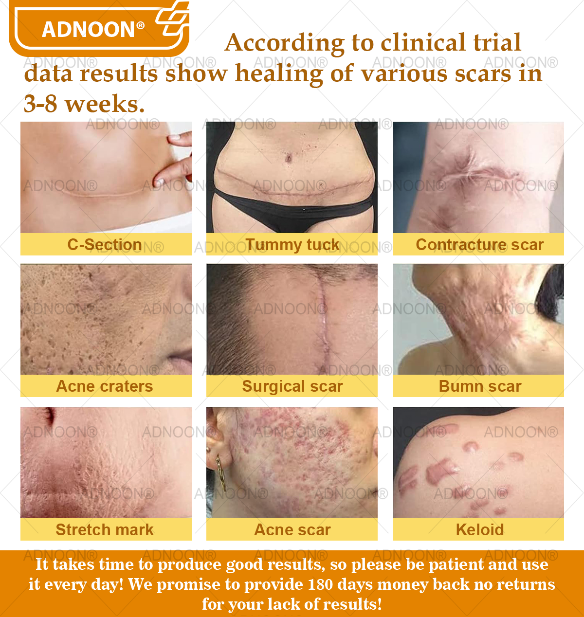 ADNOON® Bee Venom Advanced Skin Repair Cream, Anti-aging, Hydrating, Skin Repair, Even Tone, Acne and Dark Spot Treatment, Wart and Mole Removal, Psoriasis Relief