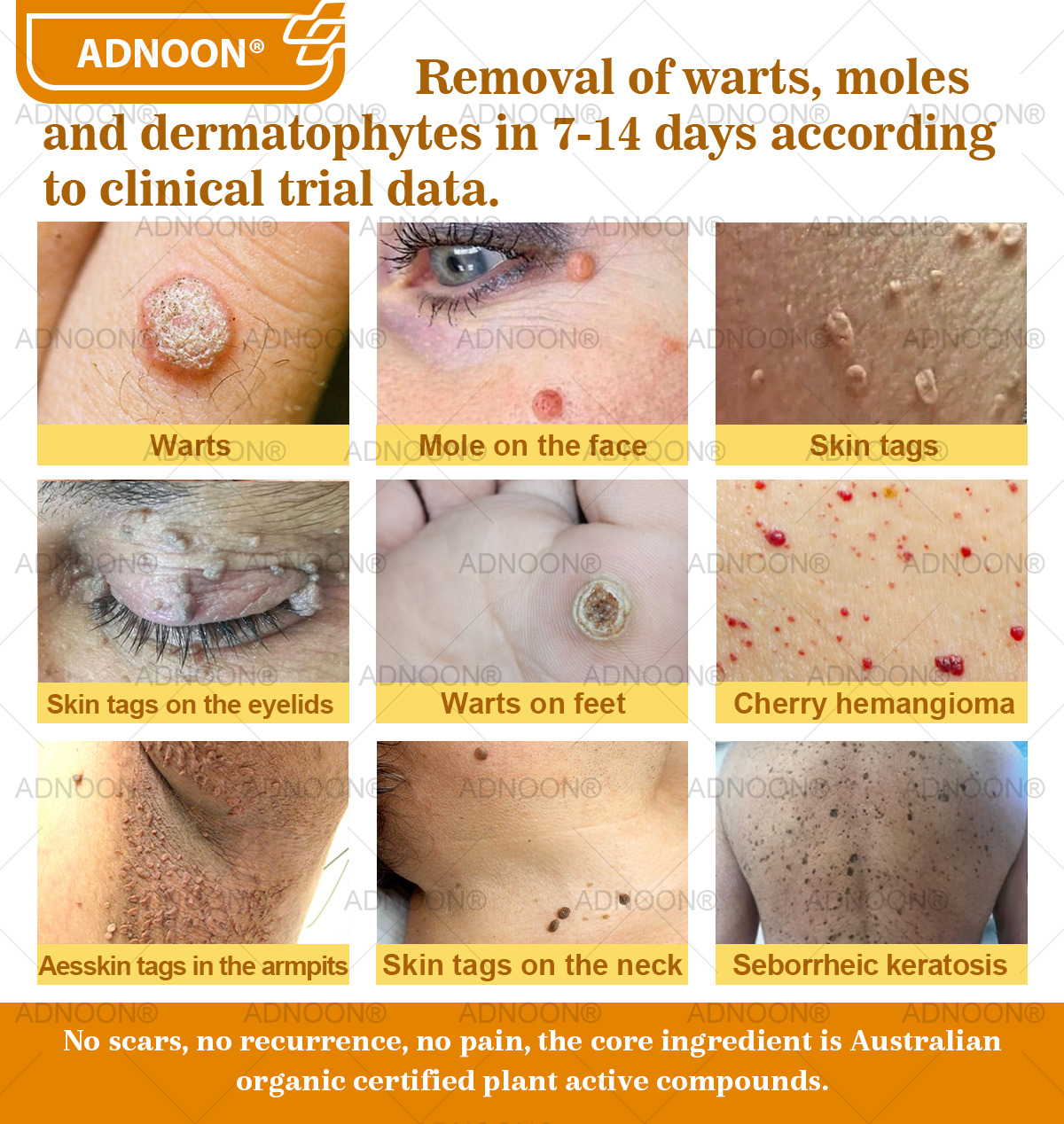 ADNOON® Bee Venom Advanced Skin Repair Cream, Anti-aging, Hydrating, Skin Repair, Even Tone, Acne and Dark Spot Treatment, Wart and Mole Removal, Psoriasis Relief