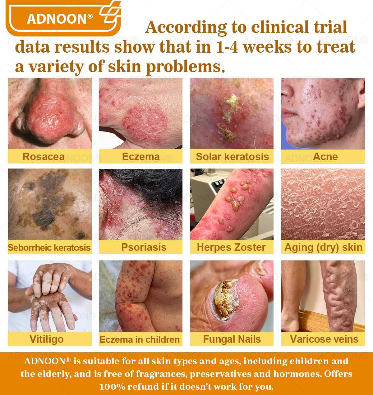 ADNOON® Bee Venom Advanced Skin Repair Cream, Anti-aging, Hydrating, Skin Repair, Even Tone, Acne and Dark Spot Treatment, Wart and Mole Removal, Psoriasis Relief